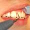 歯周病の進行予防には定期的な検査